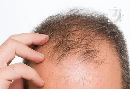 أسباب تساقط الشعر المبكر وكيفية العناية به