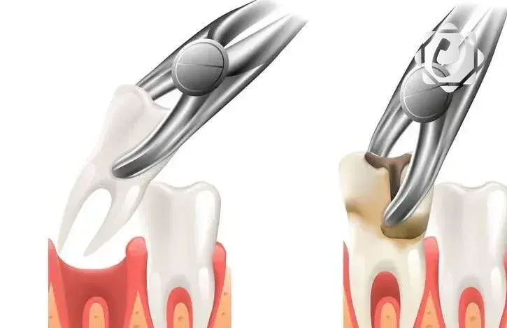 أهمية قلع أضراس العقل لتجنب مشاكل الفم