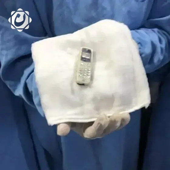 استخراج هاتف محمول من معدة مريض بعد 6 سنوات من ابتلاعه في مصر