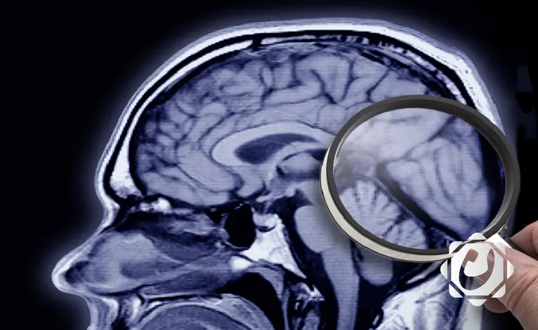 تقنية جديدة لتحفيز الذاكرة لدى مرضى الزهايمر: نتائج واعدة