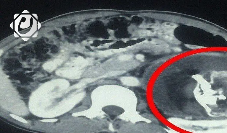 نجاح عملية استخراج جنين طفيلي من بطن رضيع في أفغانستان