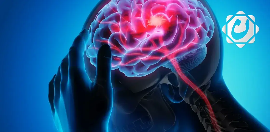 دراسة جديدة: الصداع النصفي يزيد من خطر السكتة الدماغية المبكرة بين الشباب