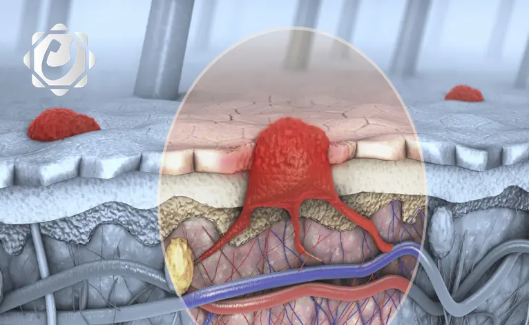 فيروس شائع يعزز فعالية علاجات سرطان الجلد ويقلل من آثارها الجانبية