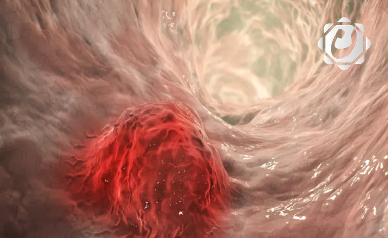 دراسة جديدة: الأسبرين للأطفال يساهم في الوقاية من سرطان الأمعاء