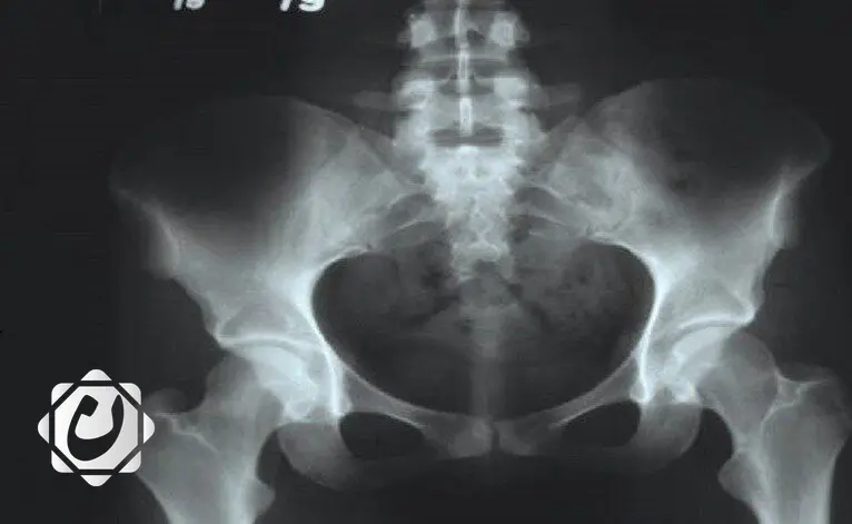 التهاب مفصل الورك: الأسباب والوقاية