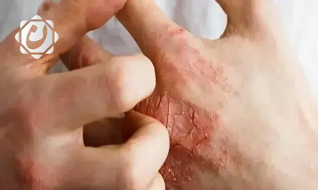 دراسة تكشف العلاقة بين الإكزيما وأمراض الكلى المزمنة