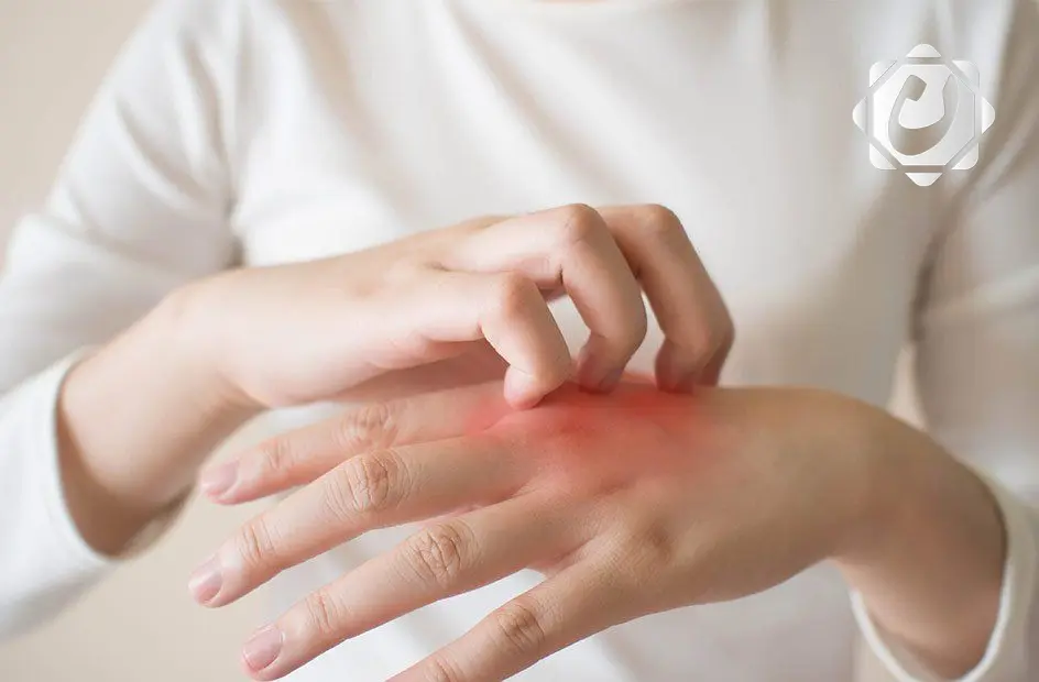 أخصائية توضح نوع الحساسية التي لا يمكن علاجها