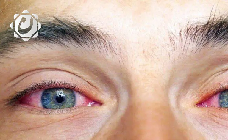 الأسباب المحتملة لظهور الأجسام العائمة أمام العين