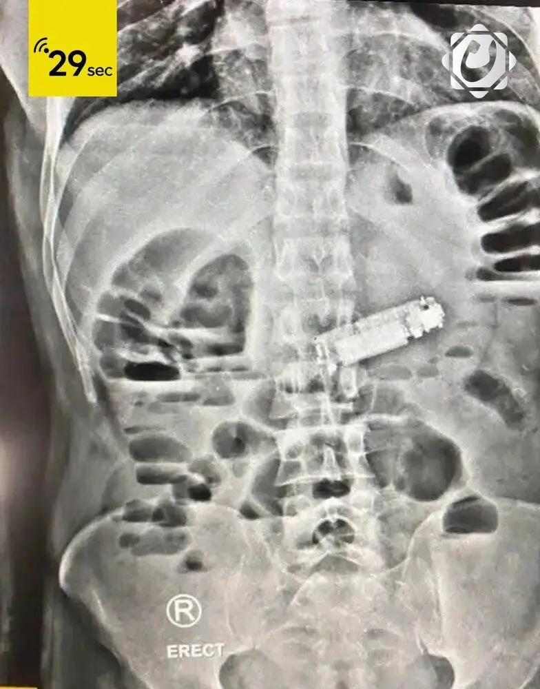 عملية جراحية ناجحة في مستشفى مصري لاستخراج هاتف محمول من معدة مريض