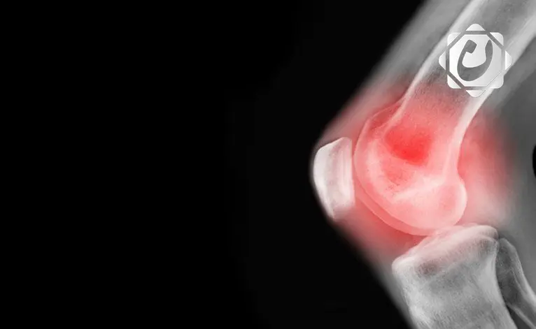 تعديل بسيط في أسلوب المشي يخفف آلام الركبة ويؤجل الجراحة لسنوات