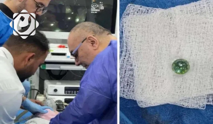 إنقاذ حياة طفل في بعقوبة بعد ابتلاعه كرة زجاجية