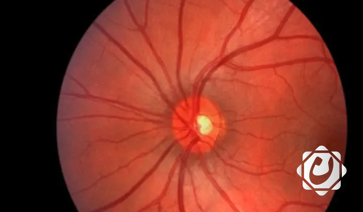 مؤتمر سعودي للشبكية 2026 يجمع 110 خبراء لبحث تطبيقات الذكاء الاصطناعي في علاج أمراض العيون