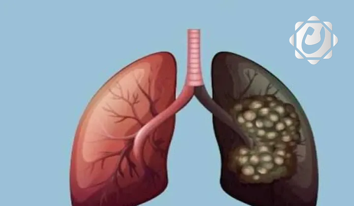 اختبار بسيط بالأظافر قد يساعد في الكشف المبكر عن سرطان الرئة